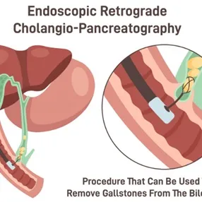 ERCP