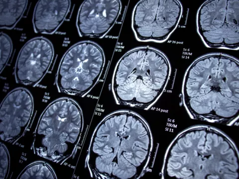 brain scan